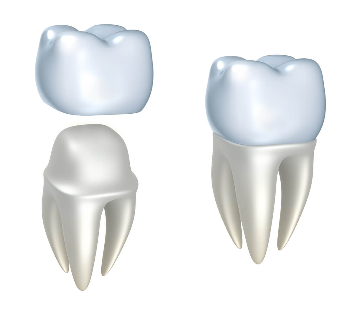 The Advantages Of A Dental Crown