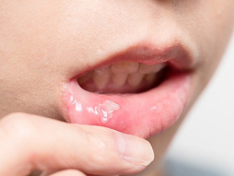 Signs Of Oral Cancer: What Not To Ignore